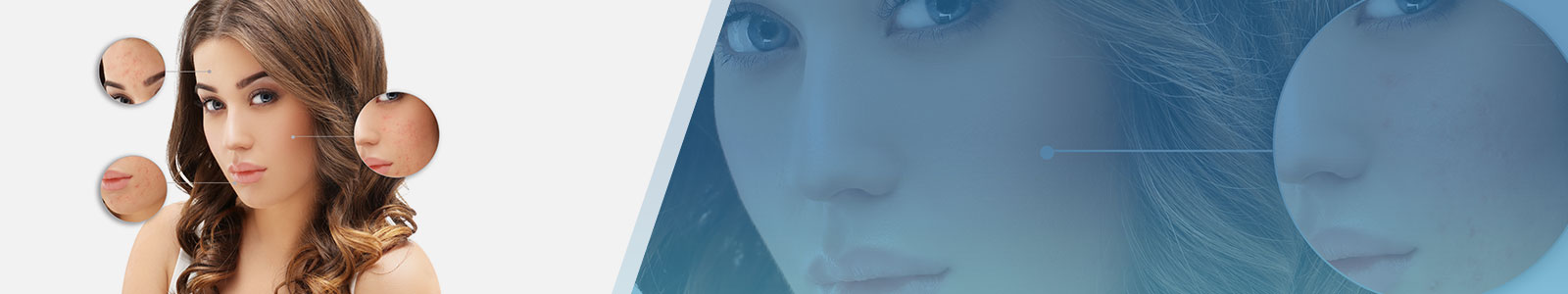 Best Acne Scar Removal Clinic in Bangalore Dr.Priyas Skin and Hair Clinic