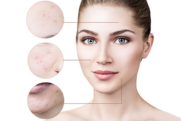 acne scar treatment cost Bangalore