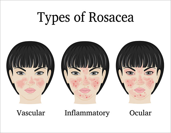 rosacea